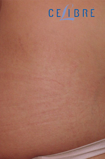 Stretch Mark Removal on Side After Picture 10