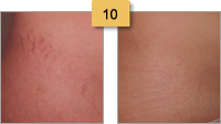 Stretch Mark Removal Before and After Pictures Sm 10