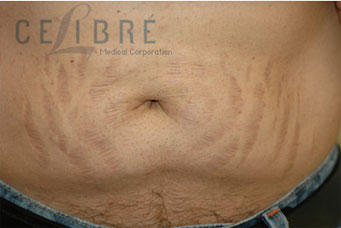 Stretch Mark Removal After Picture on Stomach 3