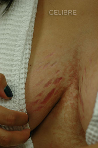Breast Stretch Mark Removal Before Picture 11