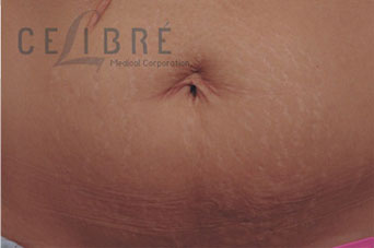 Stretch Mark Removal After Pictures 2