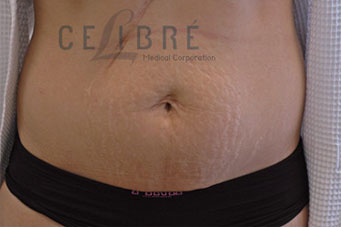 Stretch Mark Removal Before Pictures 2