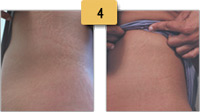 Stretch Mark Removal Before and After Pictures Sm 4