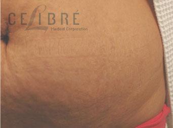 Stretch Mark Removal After Pregnancy Picture 5