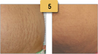 Stretch Marks Laser Treatment Before and After Pictures Sm 5