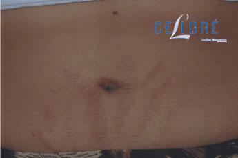 Stomach Stretch Mark Removal After Picture 9