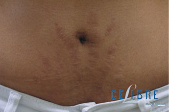 Stomach Stretch Mark Removal Before Picture 9