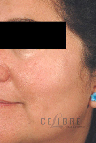 Sun Spots Laser Removal After Pictures 4