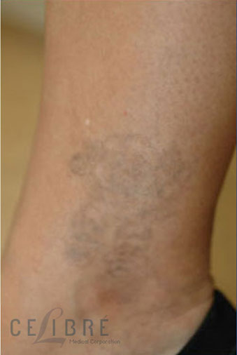 Tattoo Removal After Pictures 1