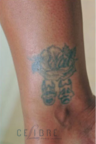 Tattoo Removal Before Pictures 1