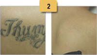 Tattoo Removal Before and After Pictures Sm 2