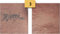 Tattoo Removal Before and After Pictures Sm 3
