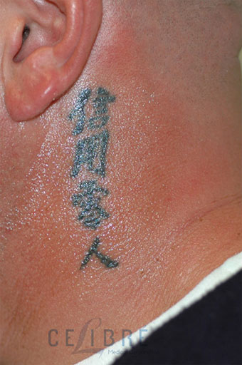 Tattoo Removal Before Pictures 4