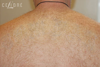 Tattoo Removal After Pictures 6