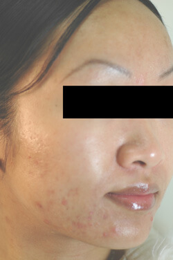 Acne patient laser treatment before and after pictures