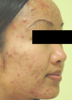 orange county california acne laser treatment before and after pictures