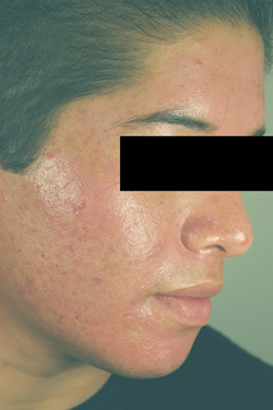 acne laser treatment photodynamic therapy los angeles