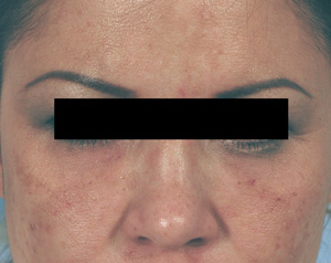 What is Restylane injections before and after photos