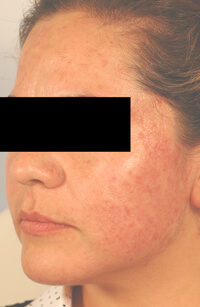 acne laser treatments & Healthy pH Balance