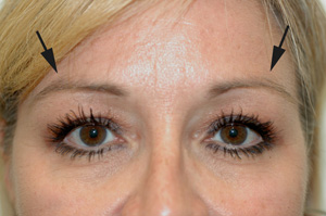 botox brow lift los angeles before