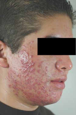 acne laser treatment photodynamic therapy los angeles