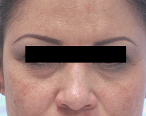 What is Restylane injections before and after photos