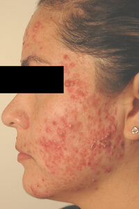 acne laser treatments los angeles before photo