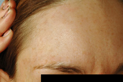 Cafe-au-lait Los Angeles Birthmark Removal Laser after photo