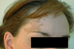 Cafe-au-lait Los Angeles Birthmark Removal Laser before photo