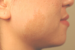los angeles laser birthmark removal with lasers before picture