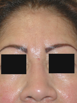 botox los angeles for frown lines before and after photos