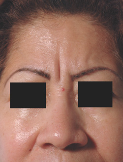 botox los angeles for frown lines before and after photos