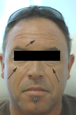 botox for men forehead before picture