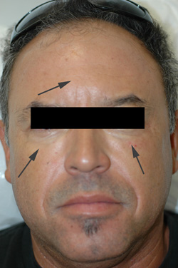 botox for men forehead after picture