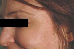 los angeles botox after picture