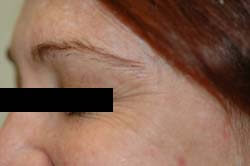 los angeles botox before picture