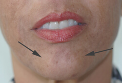 botox for pebble chin before and after pictures