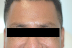 forehead botox after photo