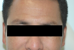 los angeles botox is botox safe before pictures