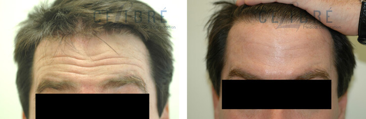 botox men forehead