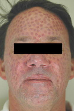 What is a Bruising Treatment for Rosacea