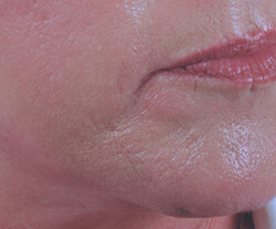 chin rejuvenation with restylane before and after pictures