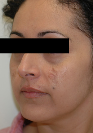 los angeles melasma before pictures