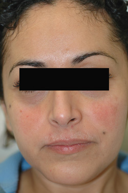 cosmelan triluma melasma after photos