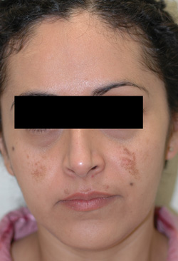 cosmelan triluma melasma before photos