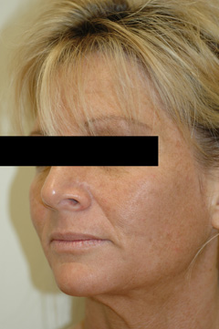 orange county laser resurfacing before photo