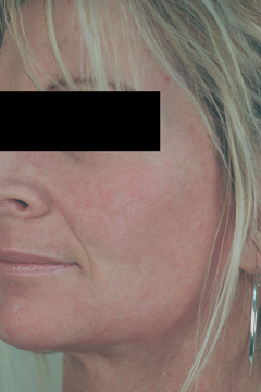 orange county laser resurfacing after photo