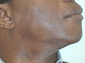 hair removal laser ingrown hairs before face permanent courthouse clinics does