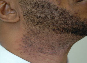 african american laser hair removal los angeles before photo