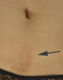 Long Beach laser scar removal before and after pictures